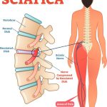 sciatica